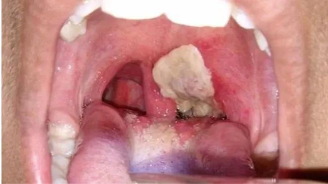 Thủ tướng yêu cầu chủ động kiểm soát, ngăn chặn, không để lây lan, bùng phát bệnh bạch hầu