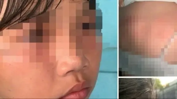Hình ảnh em Đ. bị bạn đánh gây thương tích được chia sẻ trên mạng xã hội