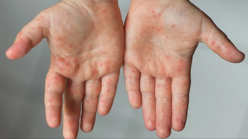 Có 170 ca mắc bệnh tay chân miệng ở Quảng Ngãi