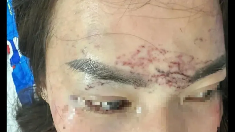 Truy tố chủ cơ sở thẩm mỹ xăm mặt “tình địch”