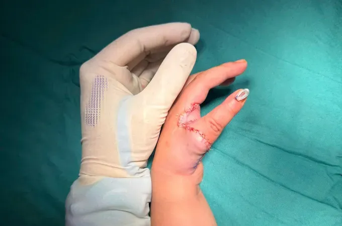 Medical workers perform pollicization surgery for child with congenital defect