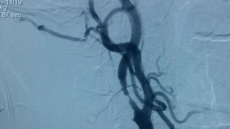Động mạch cảnh của cụ bà 86 tuổi trước khi đặt stent