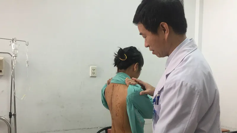Nữ sinh có cột sống cong đến 110 độ