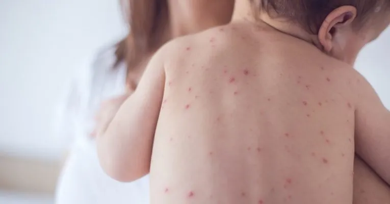 TPHCM ghi nhận 3 ca mắc bệnh sởi