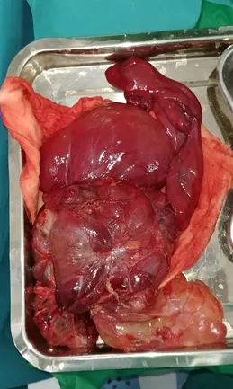 Hình chụp CT scan cho thấy khối u chiếm gần toàn bộ ổ bụng, từ vùng chậu lên đến sát gan​