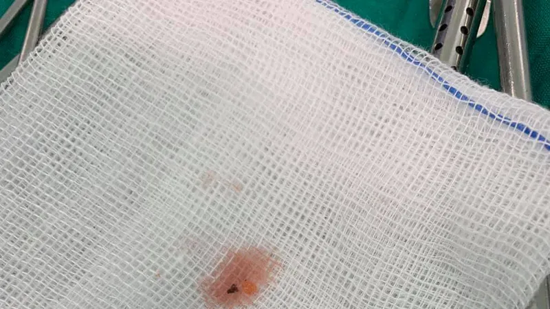 Viên đạn súng săn được lấy ra từ trong người bệnh nhi 