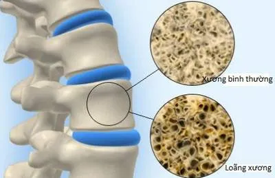 Người trẻ cũng mắc loãng xương