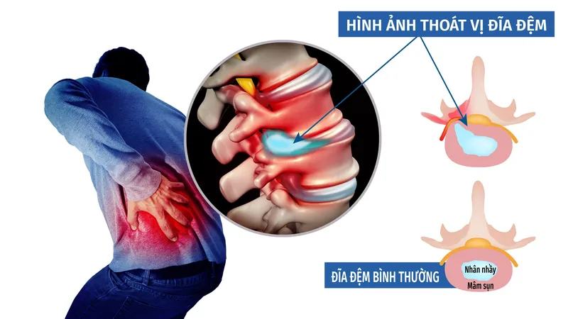 Thoát vị đĩa đệm, bệnh của cuộc sống hiện đại