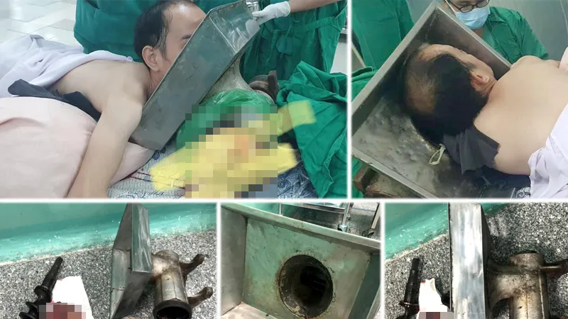 Bệnh nhân bị cuốn tay vào máy xay thịt ngập đến vai, phần tay lấy ra khỏi cối đã nát bấy