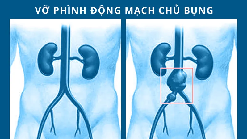 Cứu kịp thời cụ ông vỡ phình động mạch chậu chung 
