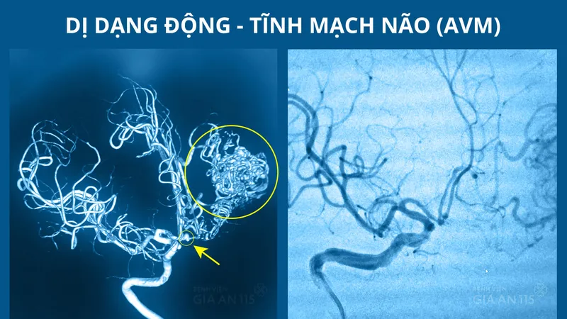 Hình ảnh chụp CT mạch máu não của bệnh nhân trước và sau khi can thiệp