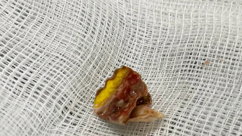 Vỏ kẹo nằm xếp lớp, gây tắc một nhánh thùy dưới phổi trái bệnh nhân