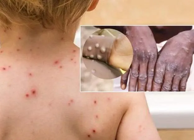 Lịch sử dịch tễ ca đậu mùa khỉ đầu tiên tại Việt Nam