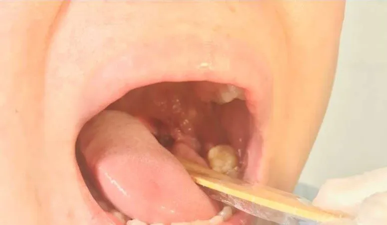 Bóng nước ở họng của bệnh nhân đã lành, hết đau