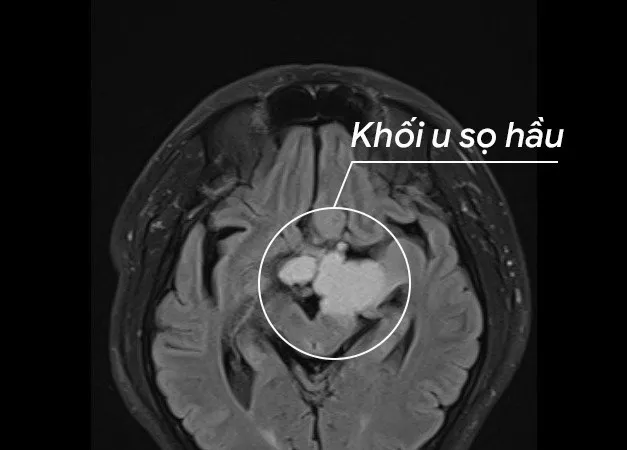 Khối u sọ hầu trong não bệnh nhân