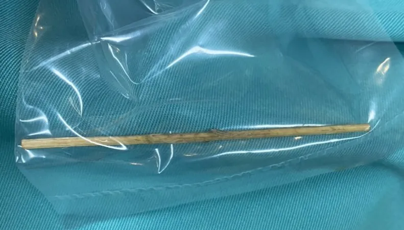 Gắp cây tăm nhọn dài 7cm nằm trong bụng bệnh nhi