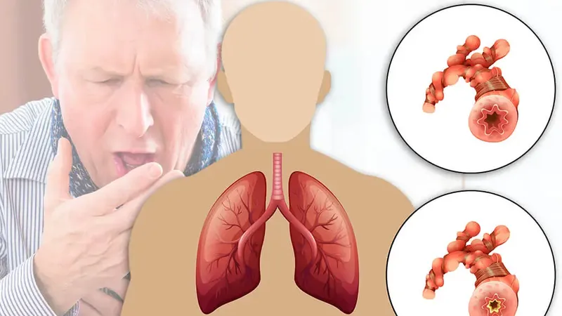 Bệnh phổi tắc nghẽn mạn tính: Âm thầm nhưng nguy hiểm