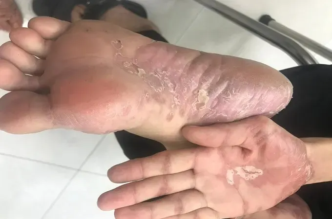 Một ca mắc bệnh giang mai điều trị tại Bệnh viện Da liễu TPHCM