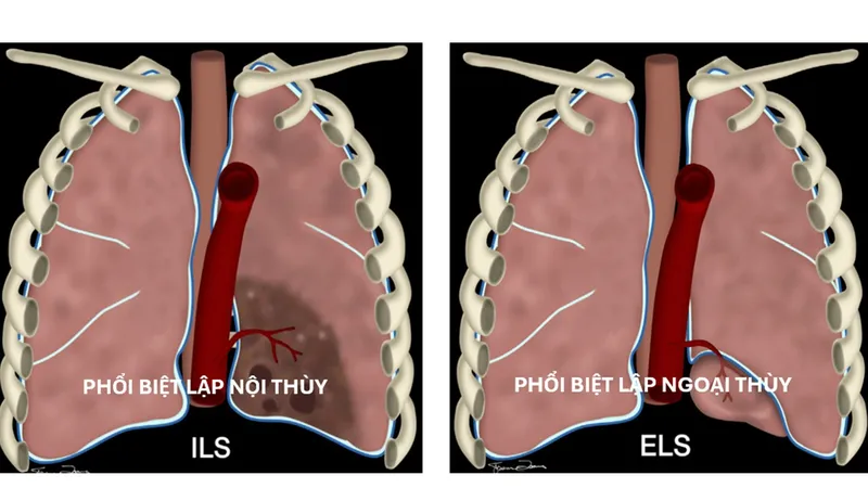 Minh hoạ phổi biệt lập nội thùy và ngoại thùy