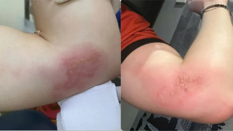 Các vết mụn nước, nhiễm trùng trên cánh tay người bệnh