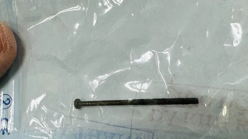Quảng Ngãi: Bé trai 3 tuổi nuốt đinh vít dài 4cm khi đang chơi đèn pin