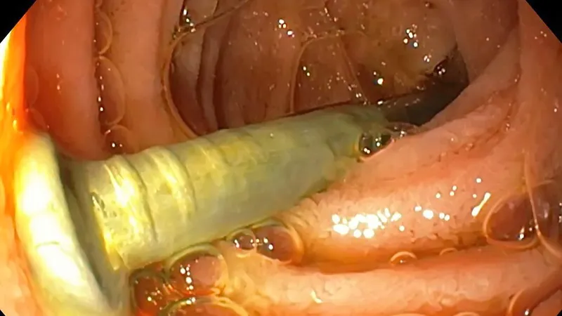 Bé trai 2 tuổi suýt tử vong vì nuốt đinh 3cm