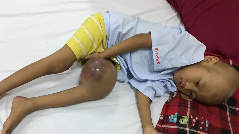 Bé bệnh ung thư cần phẫu thuật