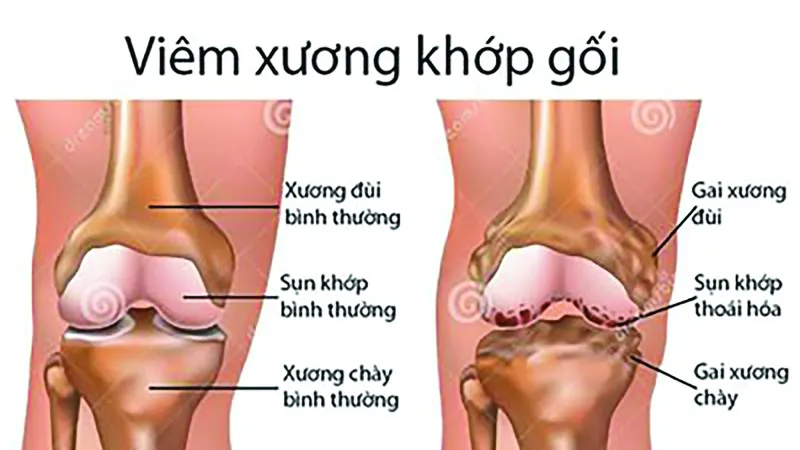 Từ biệt đau đớn do bệnh xương khớp