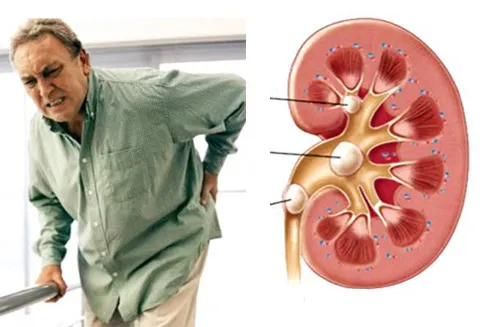 Đau mỏi ngang thắt lưng kèm tiểu đêm nhiều lần do thận hư, thận yếu phải làm sao?
