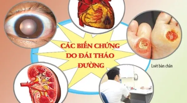 Cẩn trọng với biến chứng tim mạch trên người bệnh đái tháo đường