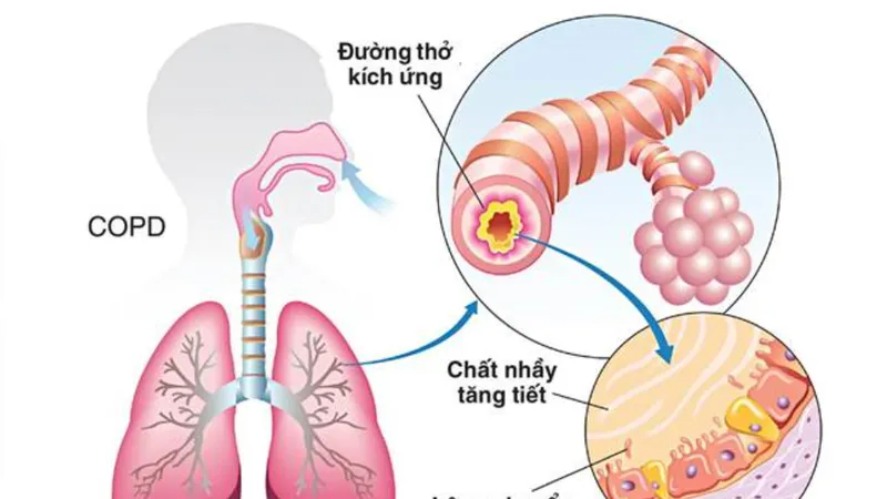 Bệnh phổi tắc nghẽn mãn tính - Sát thủ thầm lặng