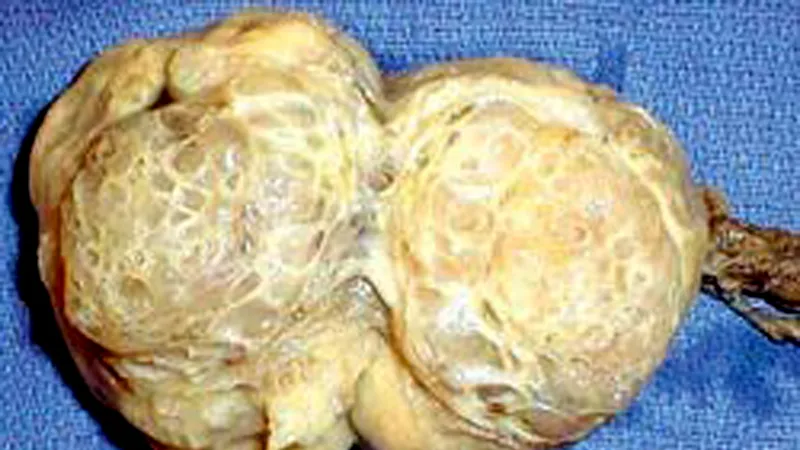 Tinh hoàn bị ung thư
