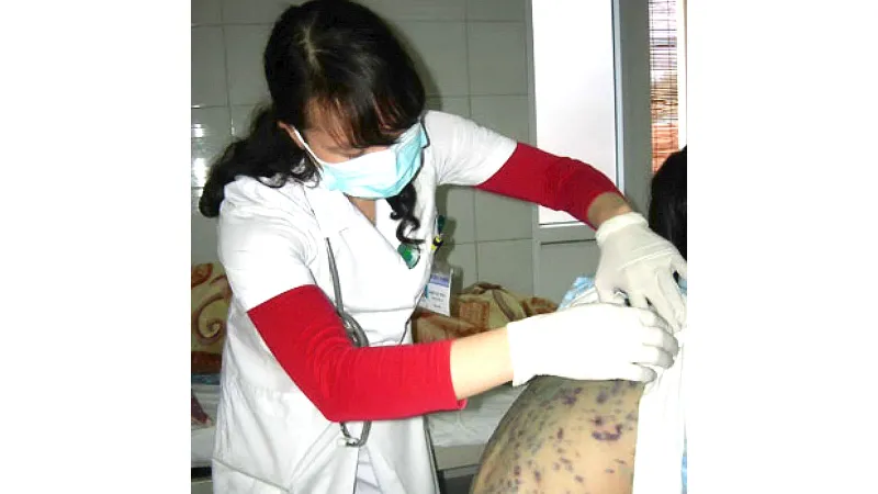 Cảnh báo dịch bệnh thủy đậu vào mùa