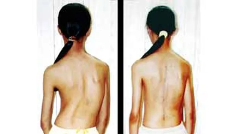 Chẩn đoán và điều trị gù vẹo cột sống ở trẻ