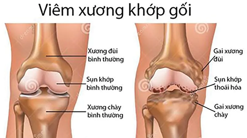 Từ biệt đau đớn do bệnh xương khớp