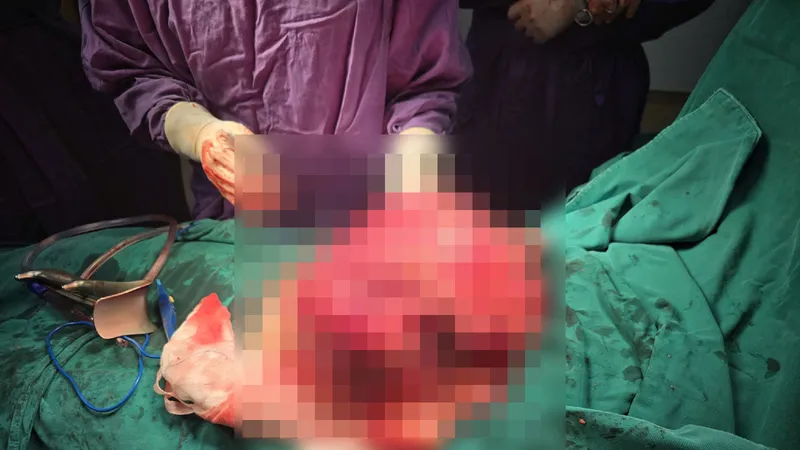 Phẫu thuật lấy khối u xơ tử cung nặng 4kg cho bệnh nhân người nước ngoài
