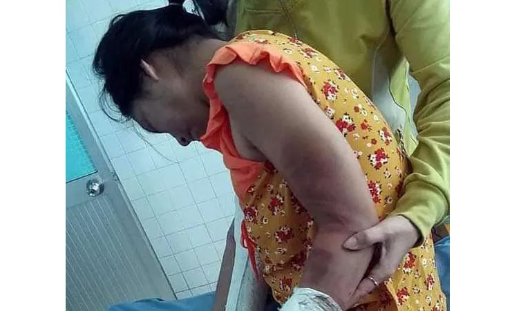Thai phụ bị người chồng hờ đánh đập dã man.