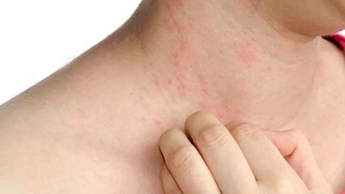 Cảnh báo dị ứng kim loại 