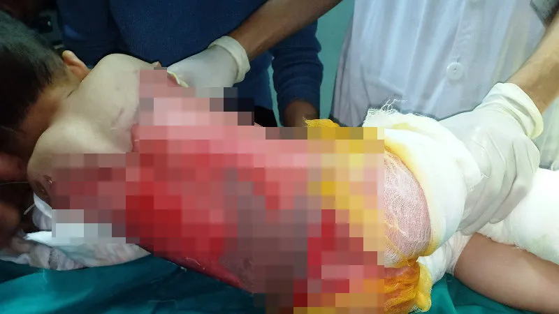 Trẻ nhỏ bị bỏng thường bị nhiều di chứng nặng nề sau này