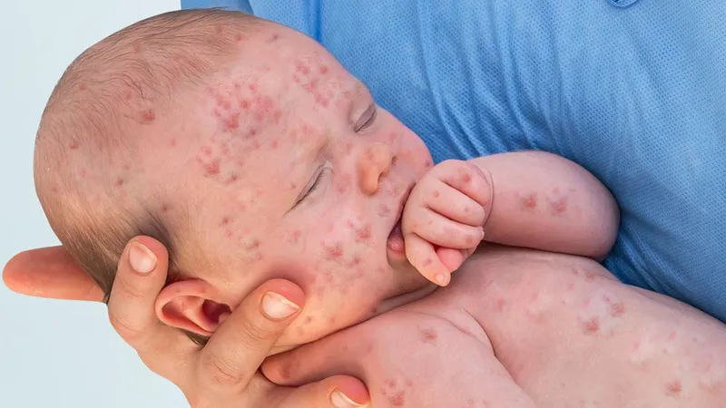 E ngại tiêm vaccine, dịch sởi bùng phát dữ dội