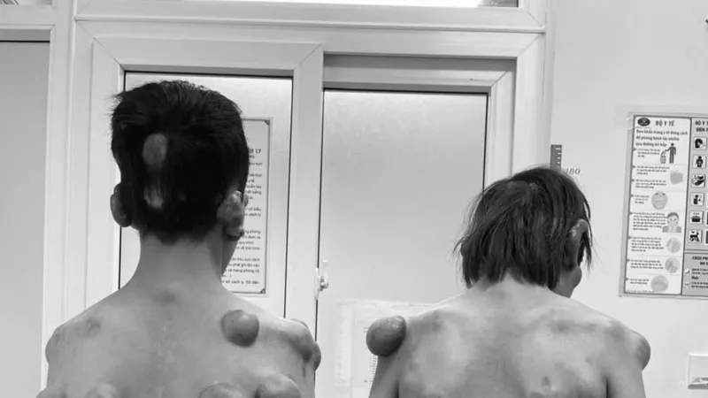 Phẫu thuật cho 2 anh em sinh đôi mắc bệnh hiếm gặp với hàng trăm khối u trên cơ thể