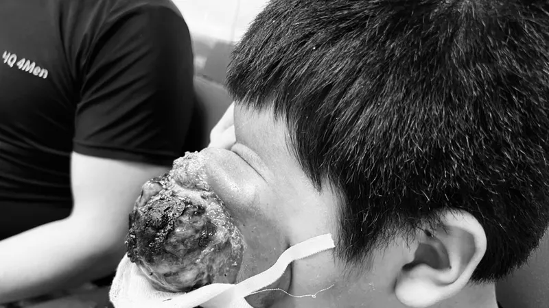 Cắt bỏ thành công khối u quái ác ở mắt cho cậu bé người Hà Nhì 