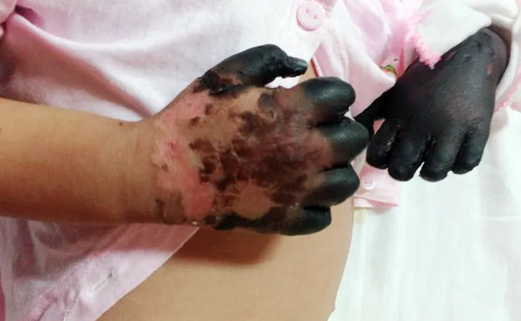 Phát hiện 3 ổ bệnh than từ trâu bò lây sang người, Bộ Y tế yêu cầu theo dõi chặt chẽ