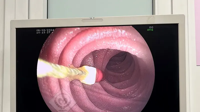 Đi chữa răng, bé trai 8 tuổi bị kim rơi vào tá tràng