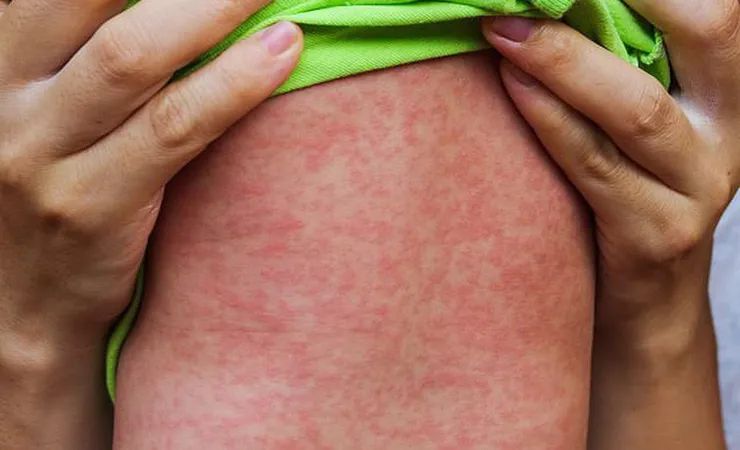 Mùa tựu trường sắp đến, nguy cơ bùng phát dịch sởi rất lớn 