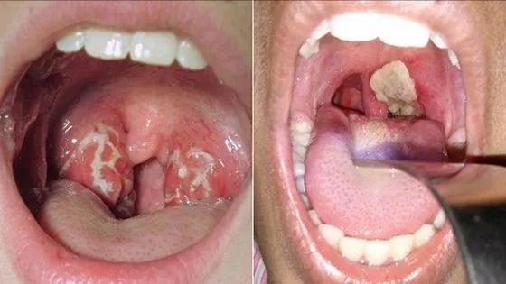 Thanh Hóa: Kiến nghị bổ sung 25.000 liều vaccine bệnh bạch hầu
