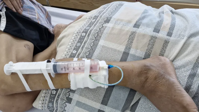 Liên tiếp ghi nhận nhiều trường hợp bị nhiễm vi khuẩn “ăn thịt người”