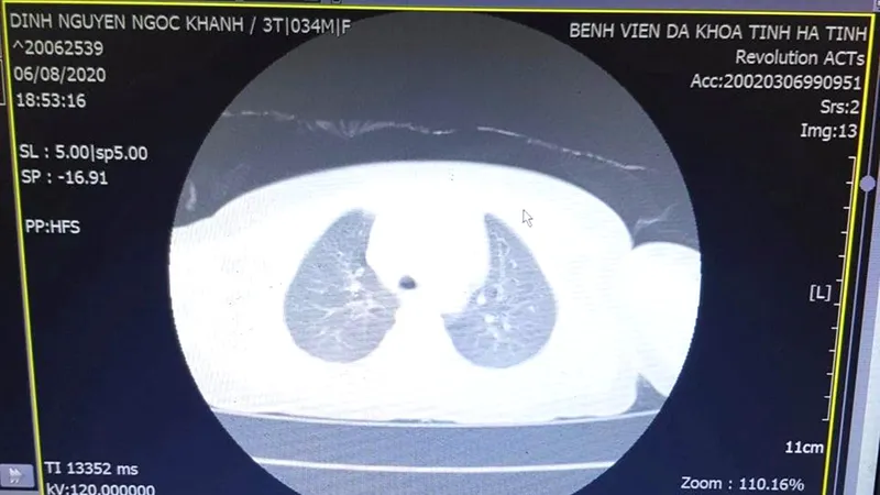 Hình ảnh dị vật thông qua chụp CT- Scanner của bệnh nhi K.