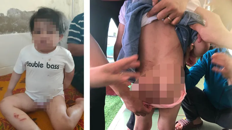 Hà Tĩnh: Một bé gái nhập viện nghi bị đánh