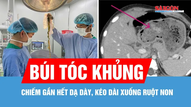 Phẫu thuật lấy búi tóc chiếm gần hết dạ dày, kéo dài xuống ruột non
